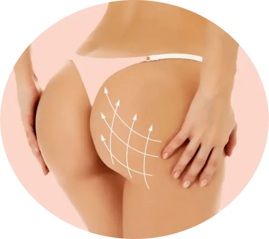 Tratamiento de glúteos