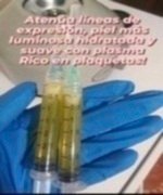 Aplicación de plasma